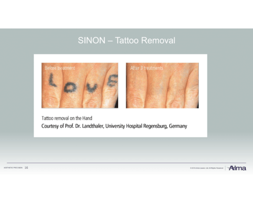 Rubinlaser Laserbehandlung in Düsseldorf Rubinlaser Laserbehandlung Tattoo entfernen bei Hautnah