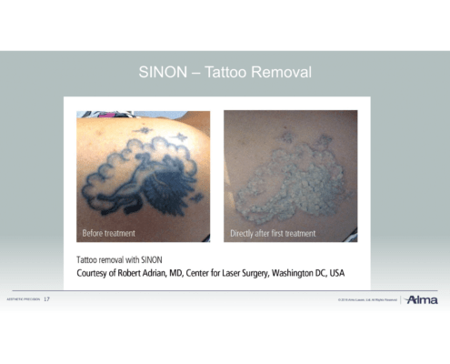 Rubinlaser Laserbehandlung in Düsseldorf Rubinlaser Laserbehandlung Tattoo entfernen in Düsseldorf