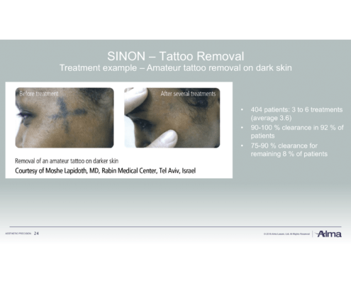 Rubinlaser Laserbehandlung zur Tattooentfernung in Düsseldorf Rubinlaser Laserbehandlung Tattooentfernung in Düsseldorf